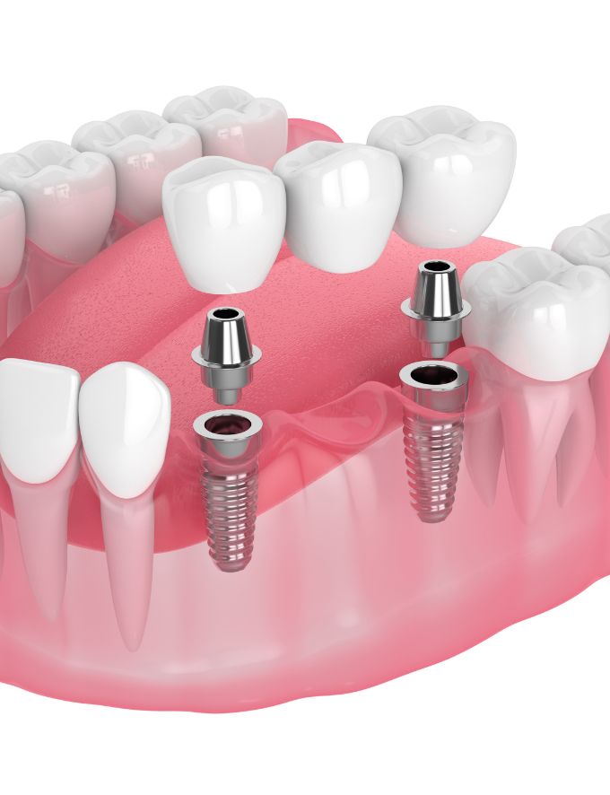 Implant retained bridges